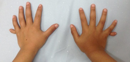 Polidactilia